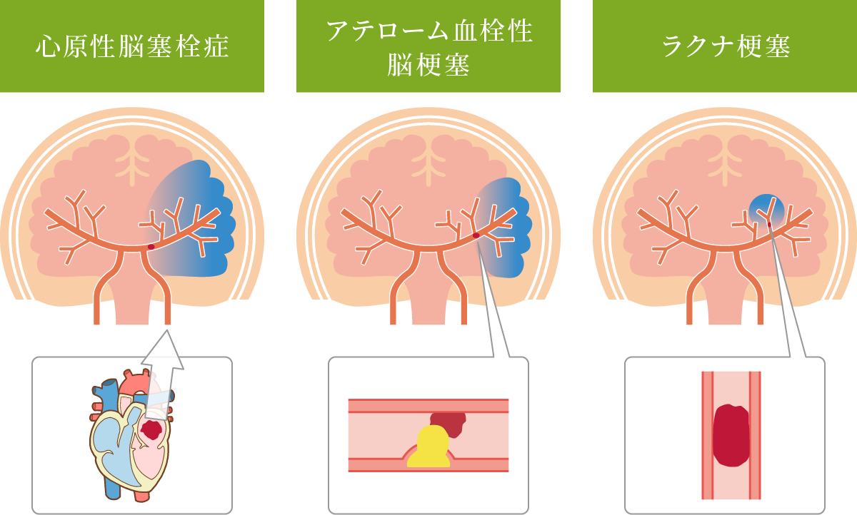アテローム血栓性脳梗塞／心原性脳塞栓症／ラクナ梗塞